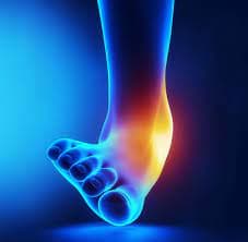 Ankle sprain