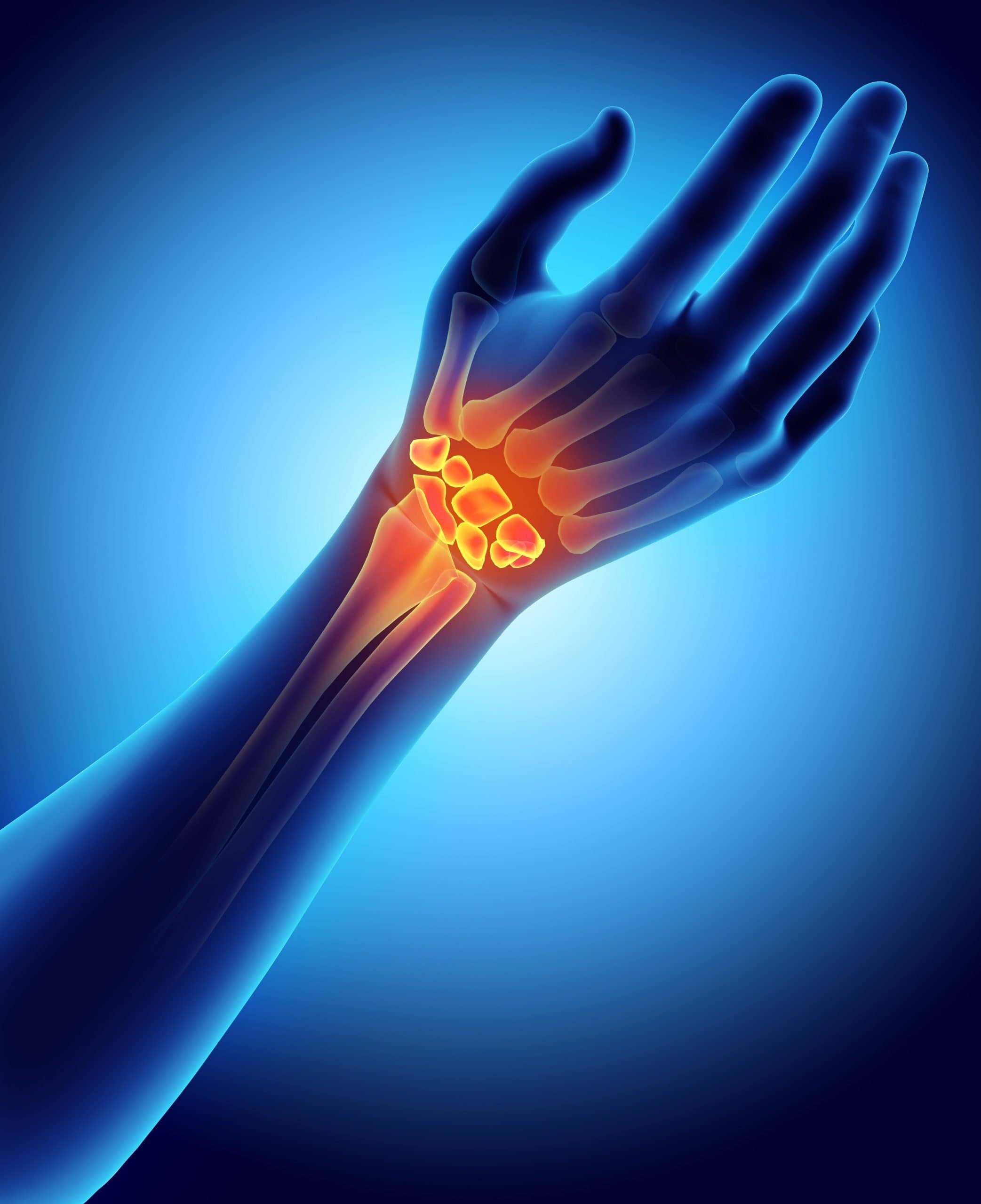 Carpal tunnel syndrome