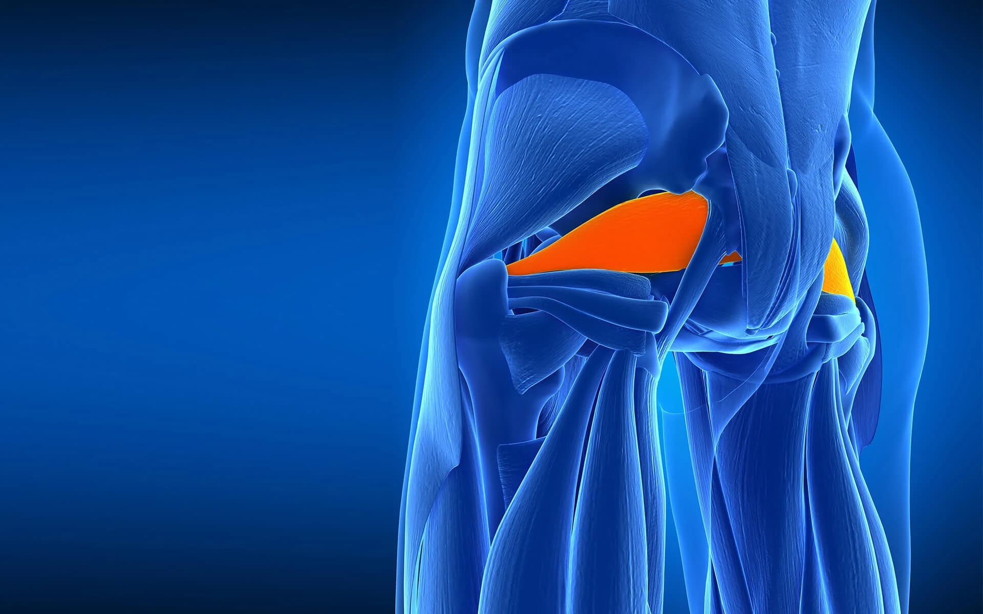 Piriformis syndrome